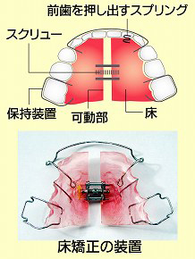 歯を抜かずに矯正