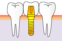 インプラントの治療行程