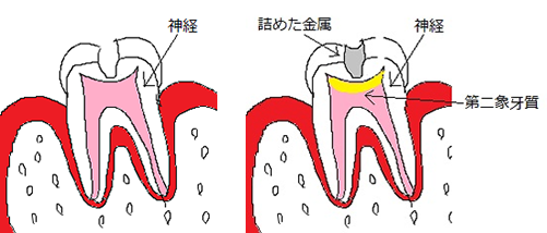 ☆治療後にシミるわけって？